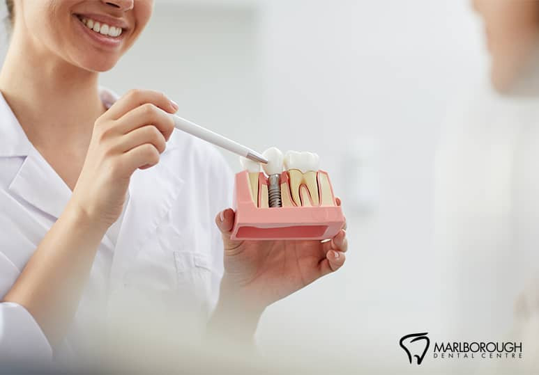 Marlborough Dental - Blog - The Stages Of Dental Implant Treatment